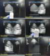 PHILIPS X3-1 P/N 453561176611 Matrix Phased Array Probe Ultrasound - Cardiac