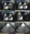 PHILIPS X3-1 P/N 453561176611 Matrix Phased Array Ultrasound Transducer