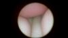 MIST 0⁰ 1.7mm 17E00R Laparoscope