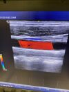 GE Logiq E Nextn Ultrasound Transducer
