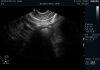 PHILIPS C8-4v Ultrasound Transducer