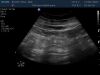PHILIPS V8-4 Ultrasound Transducer