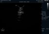 PHILIPS C9-5ec Ultrasound Transducer