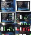 SPACELABS 90369 , W/ Module & Patient Leads ~ Multi-Parameter Monitor