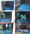 PHILIPS M8002A Intellivue MP30,W/ M3001A MMS Module & Leads ~, Monitor