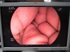 FUJINON ED-450XL5 Duodenoscope
