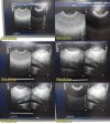 PHILIPS C8-4V Convex Array Endocavity Ultrasound Transducer