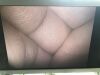 OLYMPUS A5294A Laparoscope