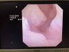 OLYMPUS CYF-VA2 Cystoscope