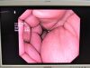 OLYMPUS GIF-XTQ160 Gastroscope