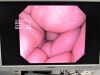 OLYMPUS GIF1TQ160 Gastroscope