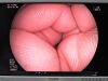 FUJINON EB-530H Bronchoscope