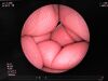 FUJINON EB-530S Bronchoscope