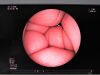 FUJINON EB-530T Bronchoscope