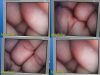 STRYKER 502-457-010 Rigid 10mmx0° Telescope, Laparoscope, Autoclavable