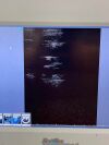 BARD Site-Rite Vision Ultrasound System 9770032 w/ Probe 9770033 Ultrasound - Cardiac - Vascular
