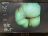 OLYMPUS BF-1T260 Bronchoscope