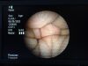 PENTAX FB-15X Endoscope