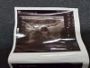 GE ML6-15 Ultrasound Transducer