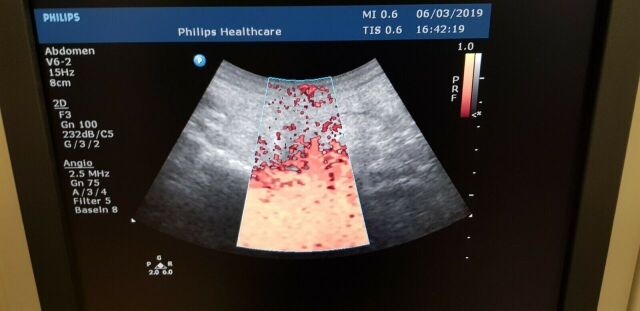 PHILIPS V6-2 Convex Ultrasound Transducer