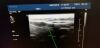 PHILIPS L17-5 Ultrasound Transducer
