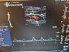 GE 12L-RS Ultrasound Transducer