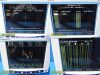 SOMANETICS Invos 5100C Cerberal Somatic Monitor