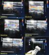 PHILIPS L9-3 Broadband Linear Array Ultrasound Transducer