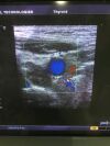 TOSHIBA PLT 604AT Ultrasound Transducer