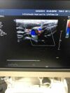 PHILIPS L8-4 Ultrasound Transducer