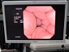 OLYMPUS PCF-160AL          Colonoscope