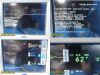 SPACELABS 91369 Ultraview SL, W/ 91496 Module & Patient Leads ~ Monitor