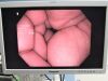 OLYMPUS CF-H180AL Colonoscope