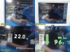 SPACELABS 91370 Ultraview SL,W/ Patient Leads & 91496 Module ~ Monitor
