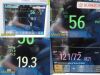 PHILIPS 2011  86135 Intellivue MP30 , W/ MMS Module & Patient Leads ~ Monitor
