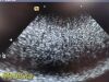 SIEMENS 2012  Medical 10V4 Vector Array Ultrasound Transducer
