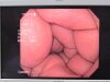 OLYMPUS CF-Q180AL Colonoscope