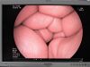 FUJINON EG-530CT Gastroscope