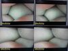 SMITH & NEPHEW ACUFEX DYONICS 7207944 Smith & Nephew DYONICS ACUFEX 7207944 Laparoscope