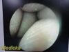 STRYKER 502-427-030 Video Rigid Telescope Arthroscope 4mmx30Ã‚Â°