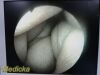 STRYKER 502-427-030 Video Rigid Telescope Arthroscope 4mmx30Ã‚Â°