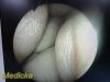 STRYKER 502-427-030 Video Rigid Telescope Arthroscope 4mmx30Ã‚Â°