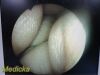 STRYKER 502-427-030 Video Rigid Telescope Arthroscope 4mmx30Ã‚Â°