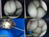 STRYKER 502-427-030 Video Rigid Telescope, 4mmx30Ã‚Â°, Arthroscope