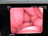 PENTAX VNL-1570STK Rhinolaryngoscope