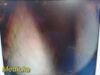 SMITH & NEPHEW DYONICS 3768 Video Arthroscope, 30Ã‚Â° 2.7mm