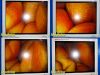 R. WOLF 8912.402 Panoview Plus 10mmx0° Rigid Telescope Laparoscope