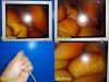 R. WOLF 8912.402 Panoview Plus 10mmx0° Rigid Telescope Laparoscope