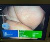 OLYMPUS BF-Q180 Bronchoscope