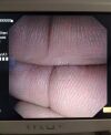 OLYMPUS TJF-140R Duodenoscope